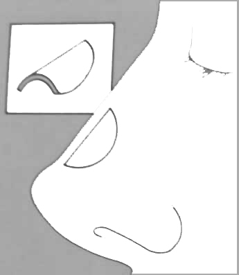 Rinoplastica Settoplastica Rinosettoplastica Prof Luigi Clauser