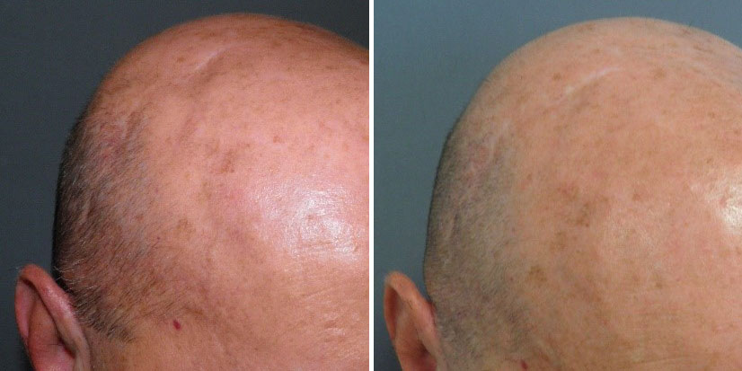 Lipofilling nella regione alta del cranio