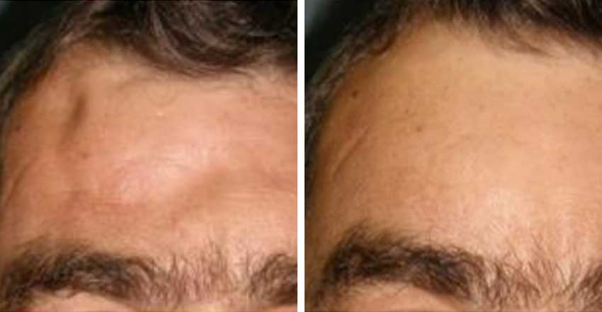 Article on frontal reconstruction
