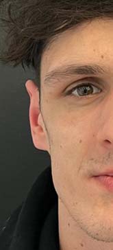 Paziente dopo lipofilling per correggere la Sindrome di Parry-Romberg
