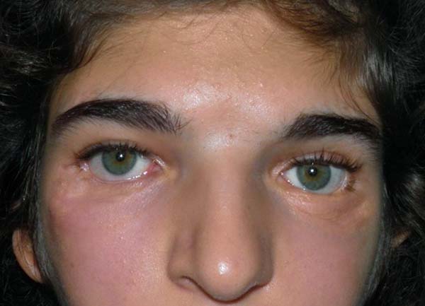Paziente con sindrome di di Treacher Collins dopo le chirurgie