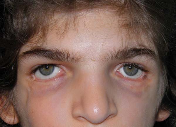 Paziente con sindrome di di Treacher Collins prima delle chirurgie